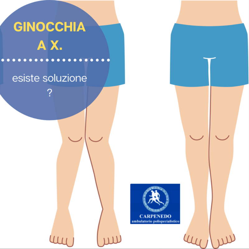 Ginocchia a X . Esiste soluzione? Ambulatorio Carpenedo Ginocchia a X . Esiste soluzione? Ambulatorio Carpenedo
